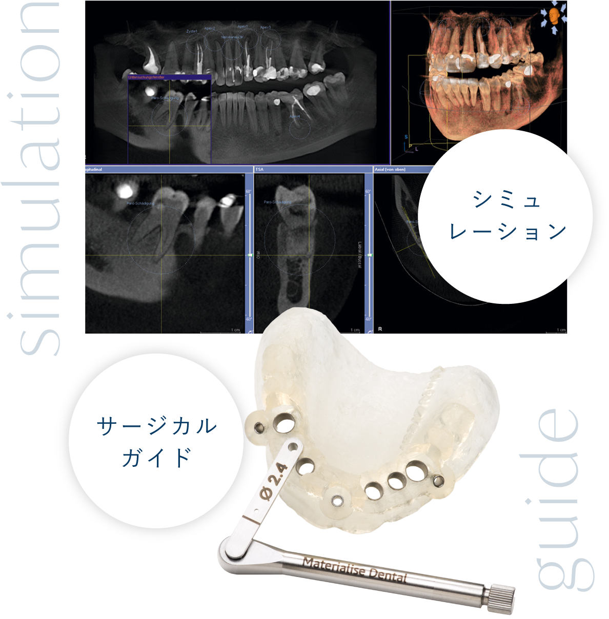 「シミュレーション」「サージカルガイド」