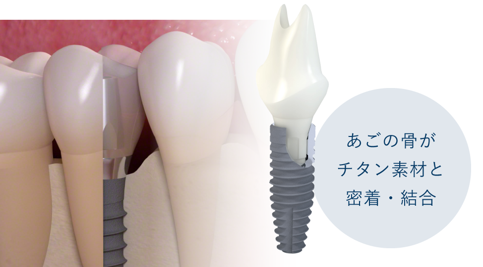 あごの骨がチタン素材と密着・結合