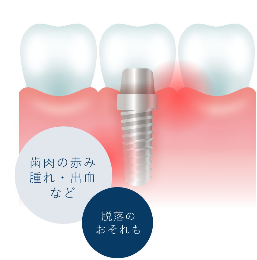 歯肉の赤み腫れ・出血など、脱落のおそれも