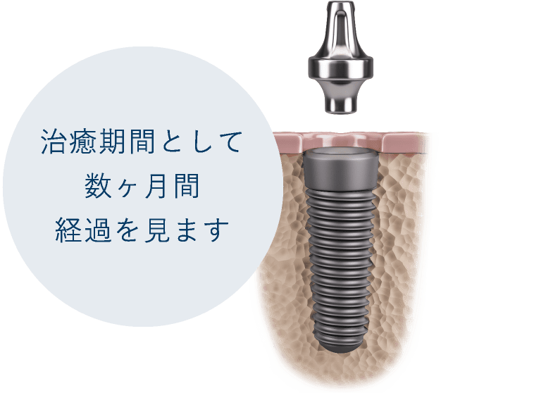 治癒期間として数ヶ月間経過を見ます
