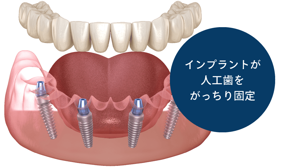 インプラントが人工歯をがっちり固定