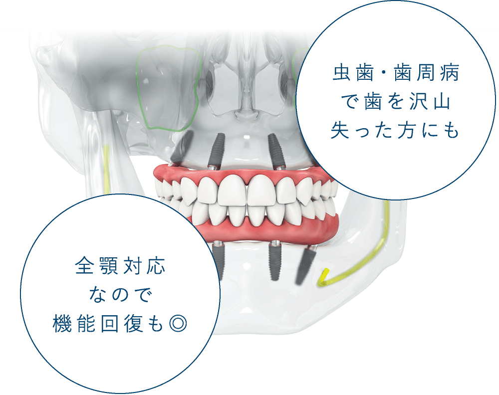 虫歯・歯周病で歯を沢山失った方にも　全顎対応なので機能回復も◎