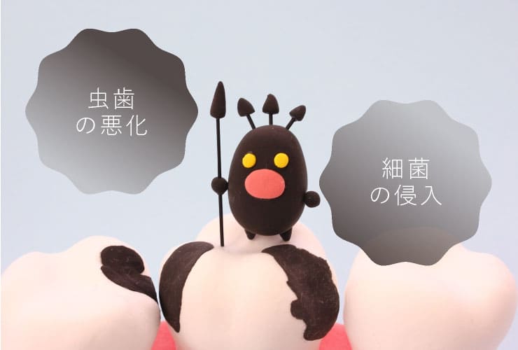 虫歯の悪化・細菌の侵入