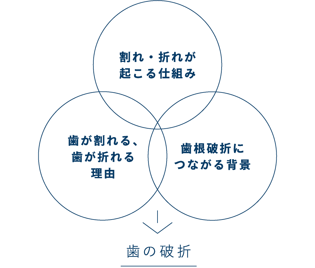 割れ・折れが起こる仕組み+歯が割れる・折れる理由+歯根破折に繋がる背景 →歯の破折