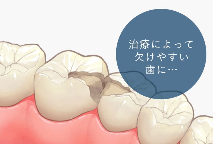 治療によって欠けやすい歯に…