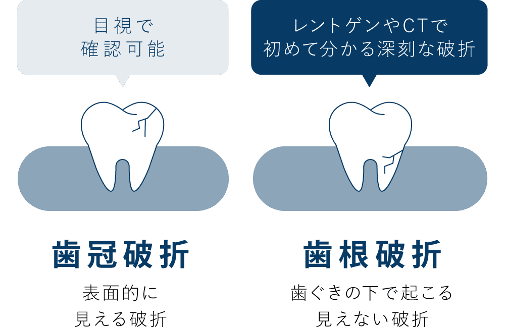 「歯冠破折」表面的に見える破折・目視で確認可能 「歯根破折」歯ぐきの下で起こる見えない破折・レントゲンやCTで初めて分かる深刻な破折