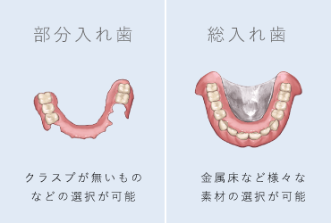 部分入れ歯：クラスプがないものなどの選択が可能/総入れ歯：金属床など様々な素材の選択が可能