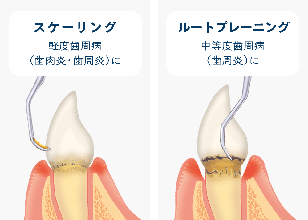 スケーリング/ルートプレーニング