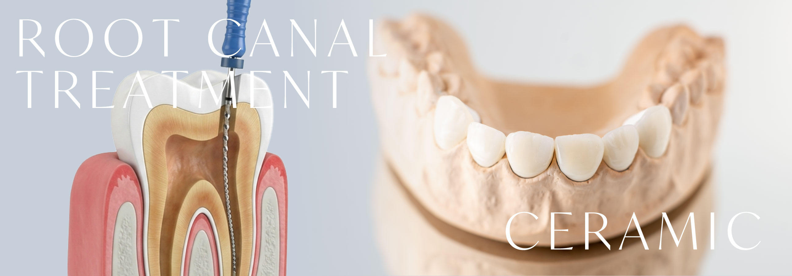 ROOT CANAL TREATMENT / CERAMIC